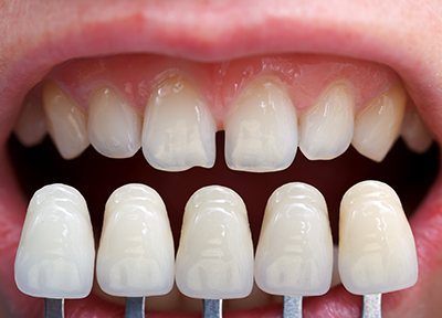 bulky veneers